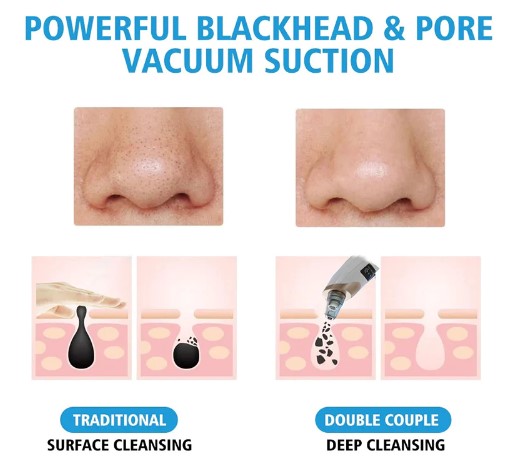 Electric Facial Blackhead Remover